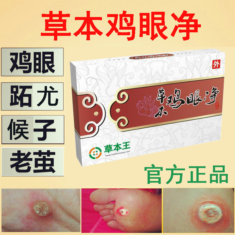 官网正品草本鸡眼净 治鸡眼药膏贴 专业去除手脚鸡眼趾尤包邮