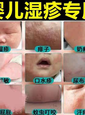湿疹婴儿专用去口水疹热疹奶藓膏