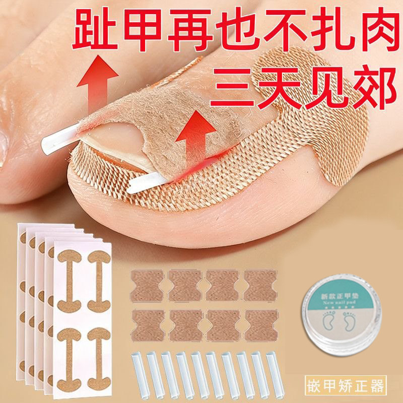 甲沟矫正器嵌甲贴片炎防脚指甲往肉里长专用工具隔离填充垫片神器