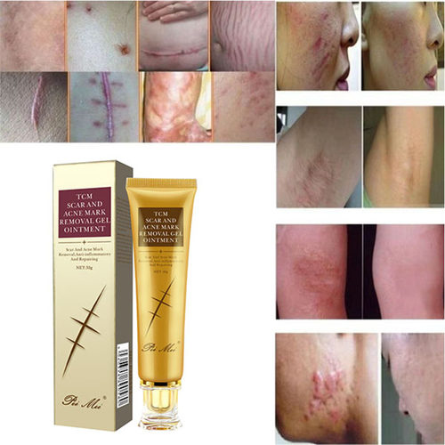 Acne Scar Removal Cream Skin Repair Face Cream Acne Spot