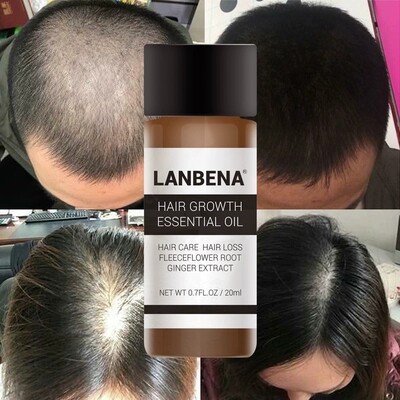 LANBENA 蓝蓓娜 Hair Growth Essential Oil 头发护理精油 20ml