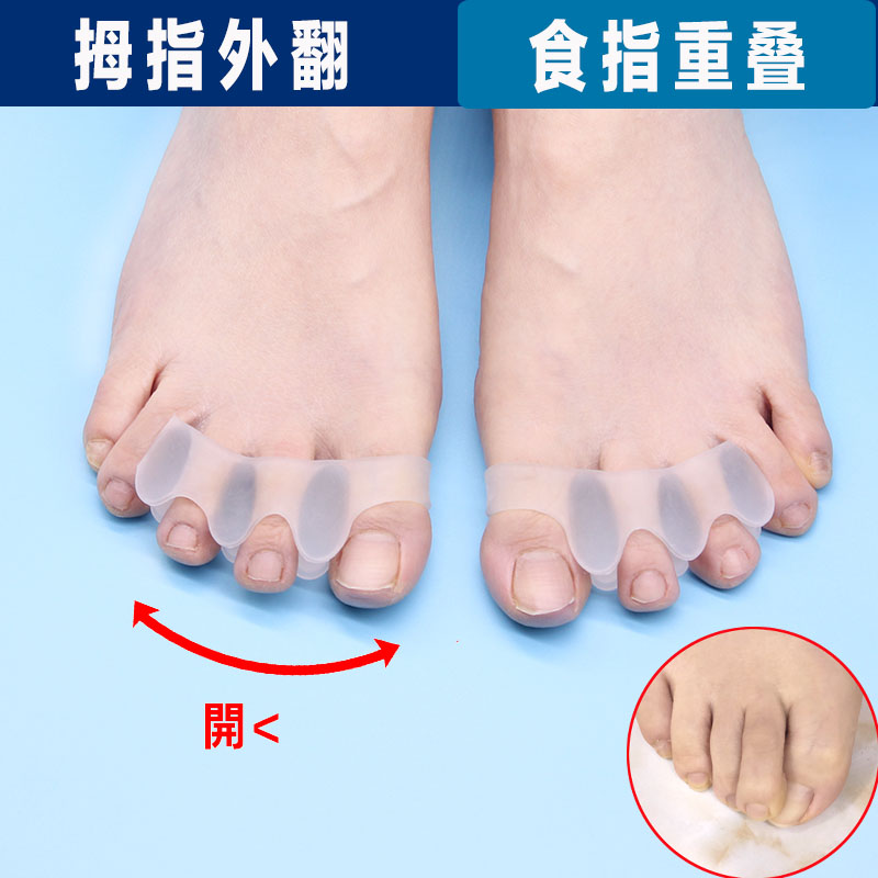 大拇指外翻重叠与二脚趾食指大脚骨弯曲二脚趾压大拇指脚指分离器