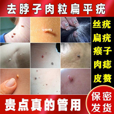 扁平疣去疣药膏祛跖疣脖子上长的小肉粒疙瘩去除膏尤瘊猴子一抹灵