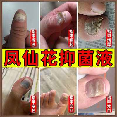 南京同仁堂凤仙花灰指甲抑菌液同瑞旗舰官方正品店坏甲空甲护理液