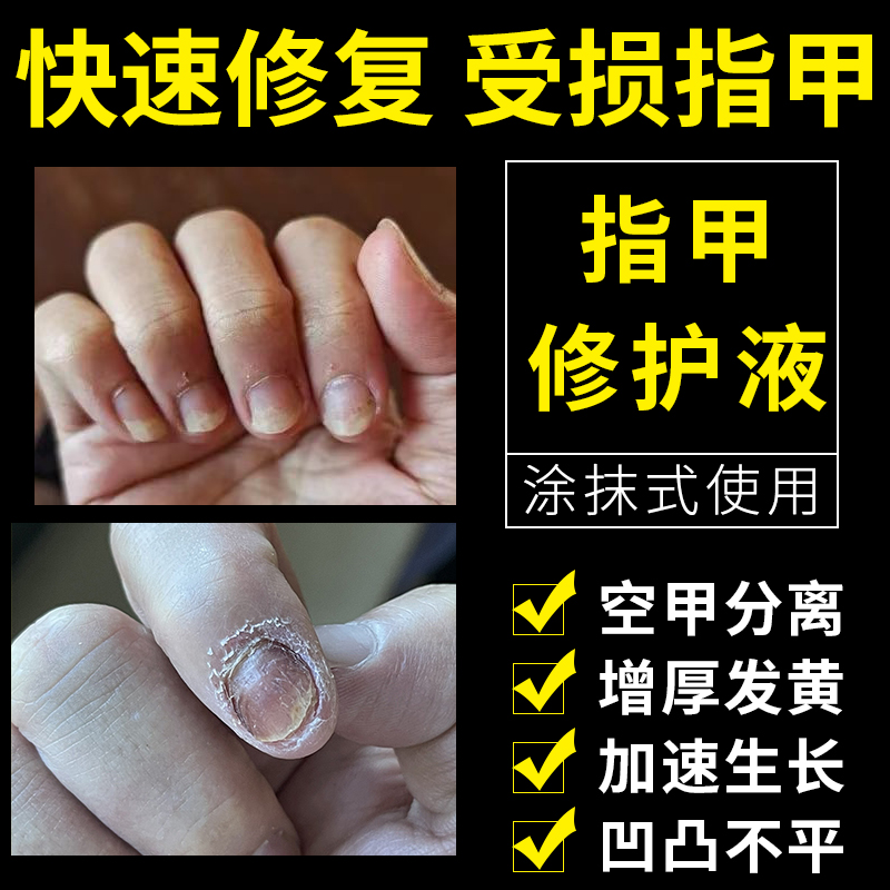 受伤指甲增厚甲肉分离空甲剥离症修复生长液竖纹凹凸不平开裂分层