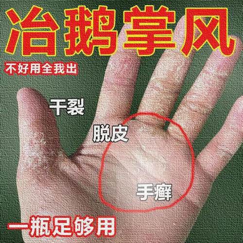 手部干鹅掌风脱外用脚裂修复霜起燥粗糙指纹护开裂脱爆指头掉严重