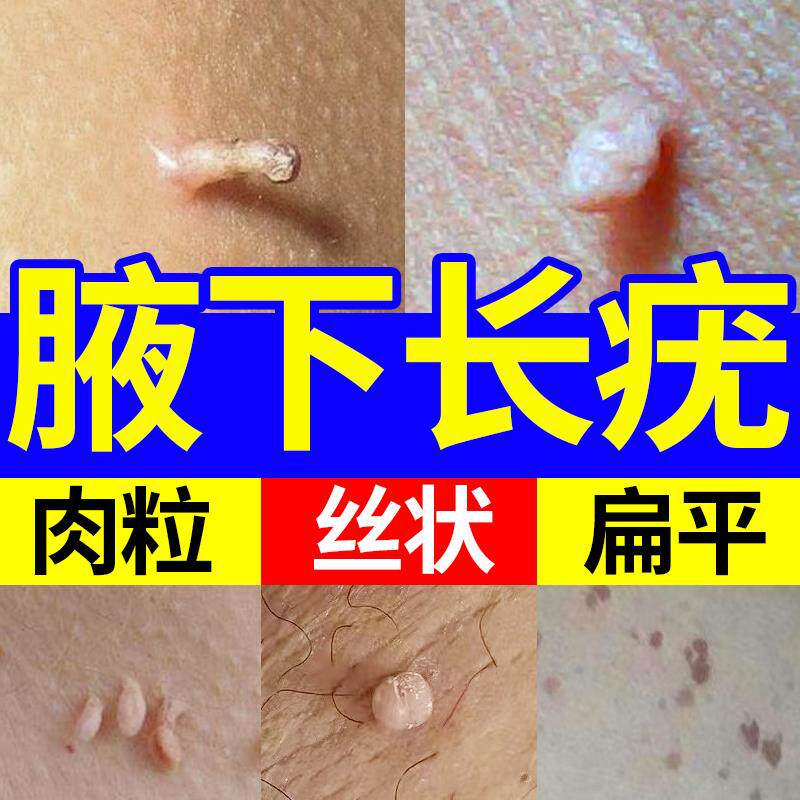 丝状疣腋下小肉粒去除扁平疣膏一抹灵尤瘊腋窝神器无忧软膏必净QY