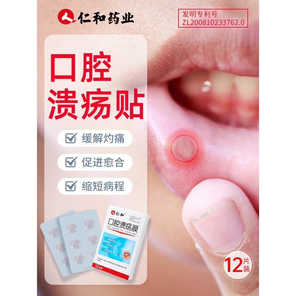 口腔溃疡贴儿童嘴巴上火舌头起泡烂专用贴口疮溃疡膜黏膜一口贴片