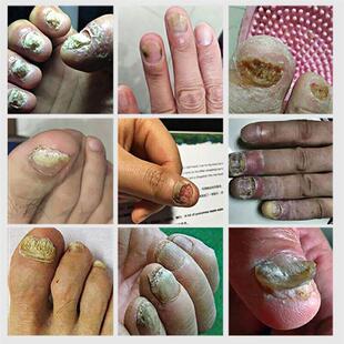Repair Toe 30ml Nail CareTreatment Foot Feet Fungal Essence