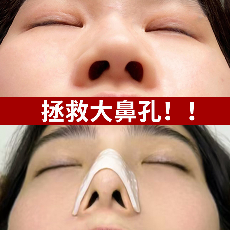 热塑鼻夹板！鼻翼缩小矫器自捏塑形美鼻术后固定正热缩夹鼻子神器