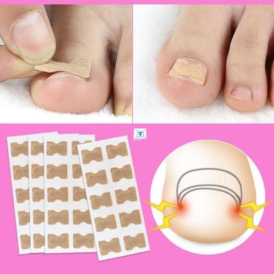 10/20PCS Ingrown Toenail Correction Stickers Glue Free Ing