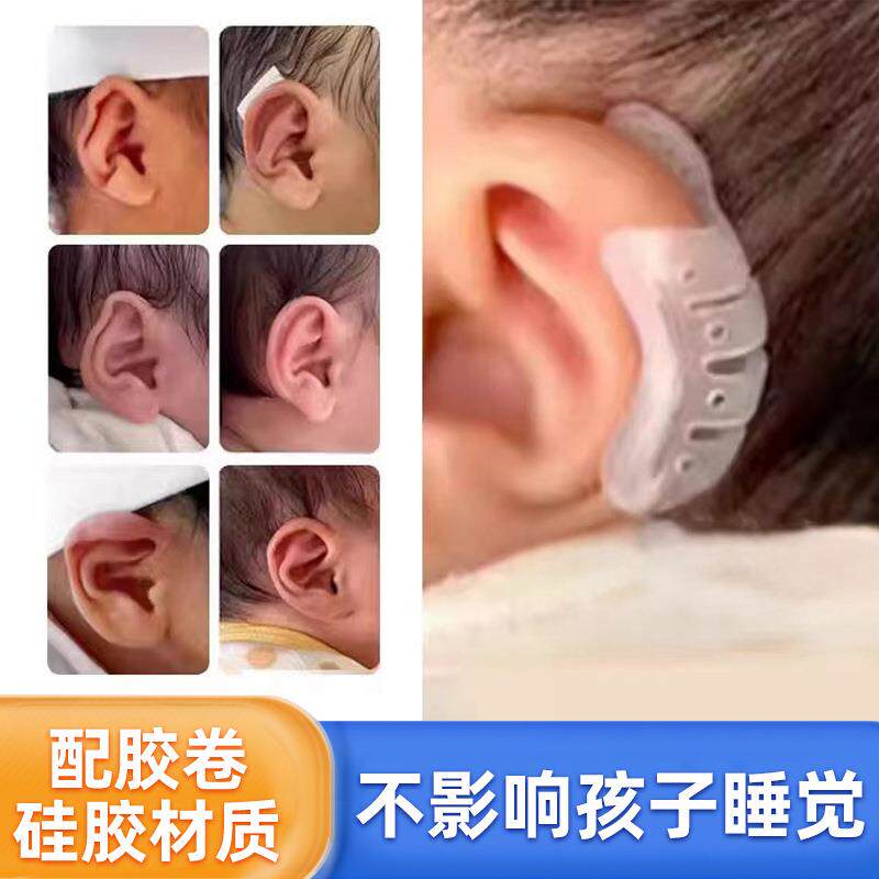 硅胶婴儿耳朵矫正器耳廓矫形新生儿畸形耳型垂耳纠正新生儿矫正