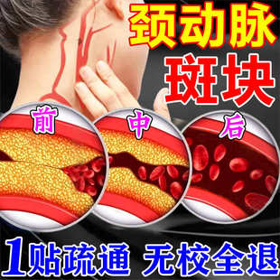 颈动脉斑块疏通软化血管堵塞狭窄硬化粥样化缓解脑梗供血不足头晕