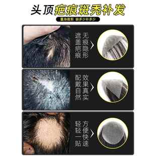 疤痕补发贴伤疤头顶斑秃假发贴全真发定制生物头皮粘贴男女补发片