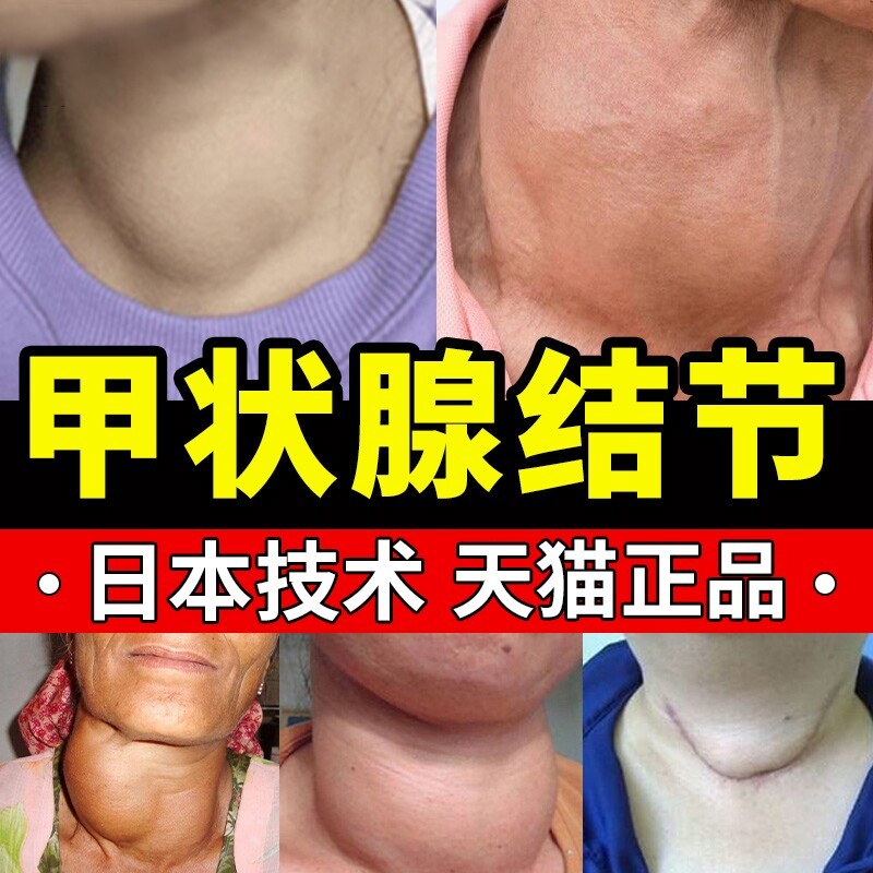 甲状腺结节消散结贴专用特效冷敷凝胶正品甲亢脖子淋巴结消肿大膏