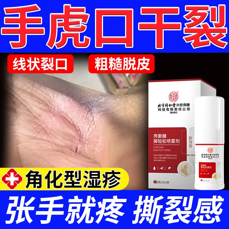 裂手虎口足开裂角化型湿疹线状口粗糙皴干性手癣真菌感染喷雾剂RW