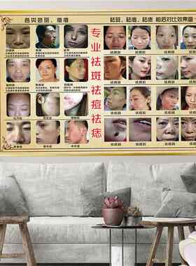 专业祛斑祛痘对比图祛痣广告点痣海报男女面痣图中药祛斑图片挂画