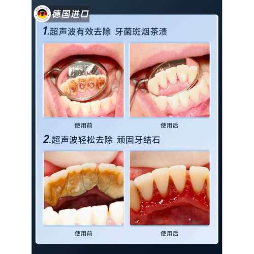 德国进口可视洁牙器超声波洗牙除牙石家用牙结石去除洁牙仪电动美