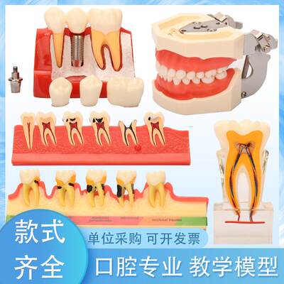 牙齿模型牙科种植六倍大龋齿病理修复正畸假牙口腔医院教学摆件