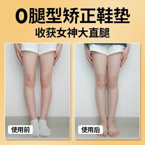 成人直腿神器o型X型小腿外翻矫正鞋垫扁平足弓支撑垫鞋防止鞋底磨