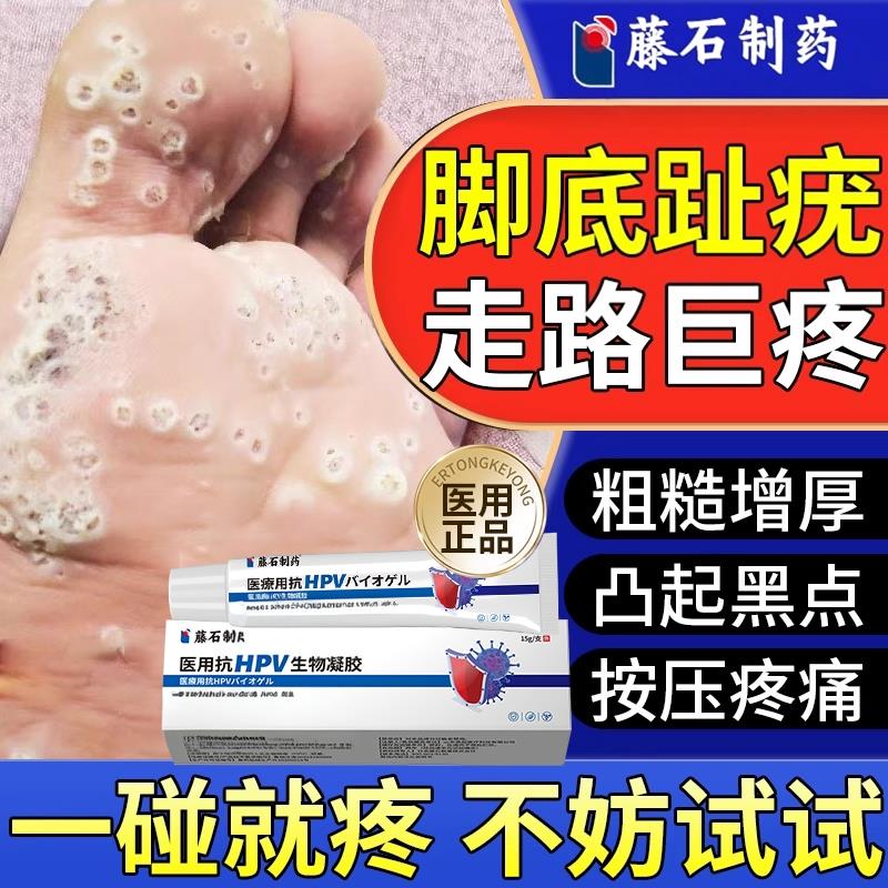 跖疣膏干素扰去寻常疣病毒拓趾去除足部脚底疣肉刺水杨酸CA医星熊