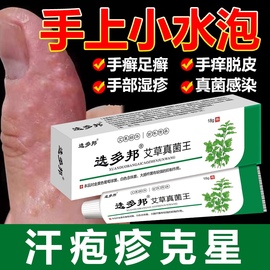 汗泡疱疹鹅掌风特效汗状孢疹手癣专用软膏手上起小水泡脱皮痒药膏