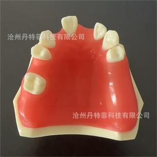 种植练习模型种植牙缺失模型牙齿种植模型