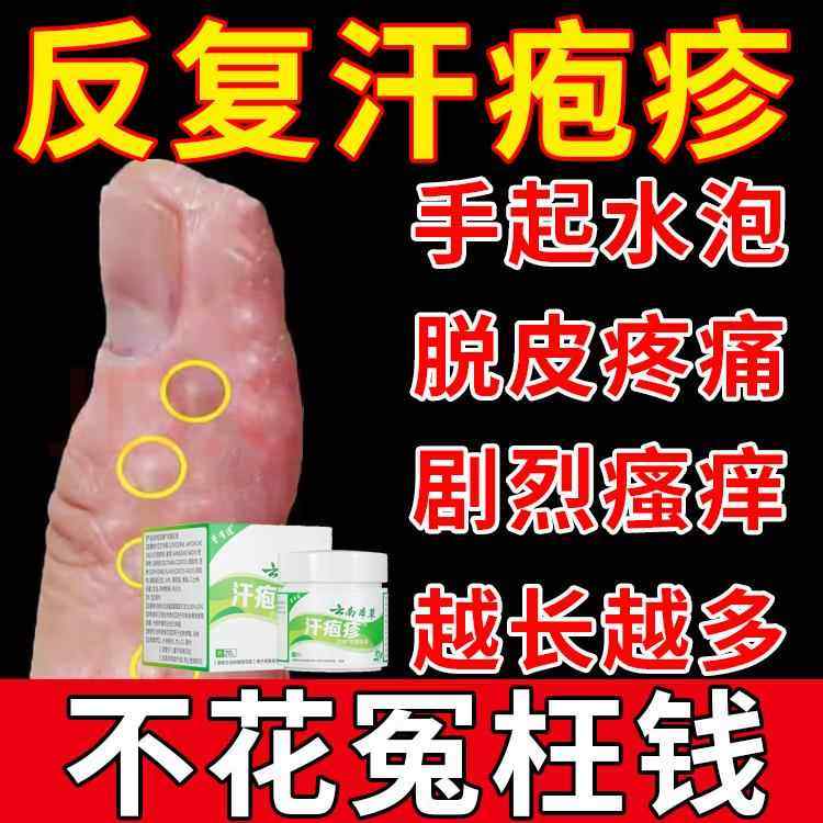 日本汗状泡疱疹药膏起小水泡去手脚脱皮止痒真菌感染克 克星81242,保健用品,皮肤消毒护理（消）,淘宝优惠券,粉丝福利购,淘宝优惠卷