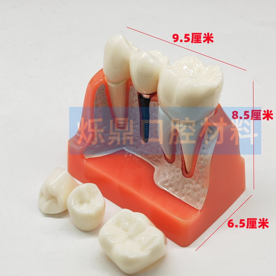 牙科牙模型种植模型4钉上下颌 2钉下颌单颗水晶4倍牙模齿科教学