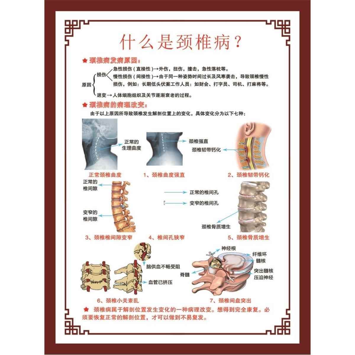 什么是颈椎病?海报颈椎病颈椎病科普颈椎病展板挂图装饰画贴纸