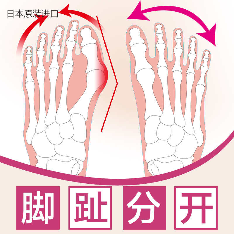 日本大拇指外翻脚趾矫正器纠正矫形分指重叠趾头男女大脚骨分趾器