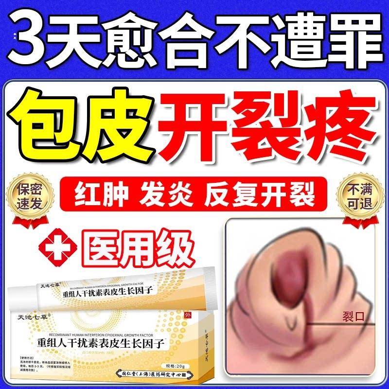龟头包皮炎症开 裂口发炎真菌感染红肿白垢破裂开 龟头炎男科药膏
