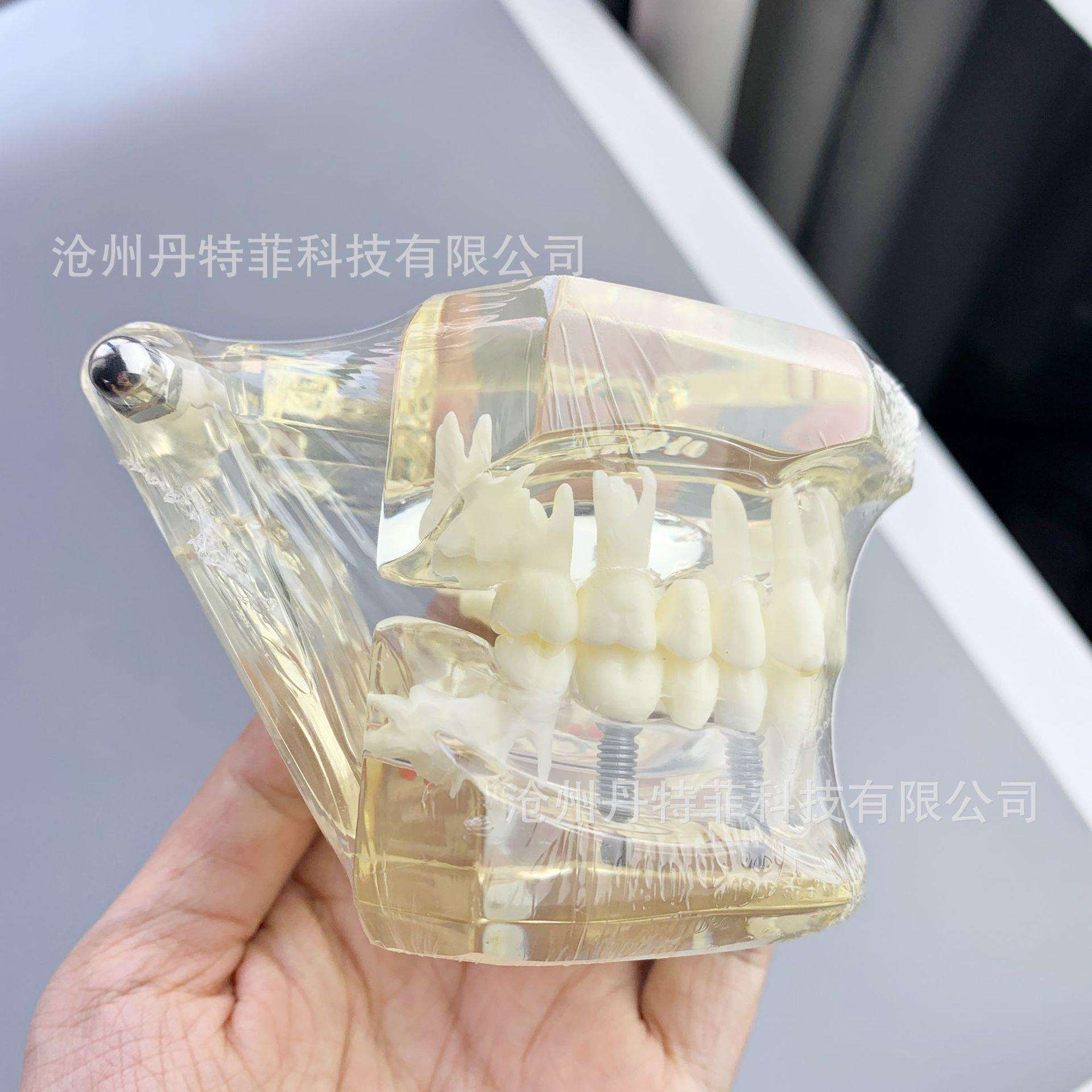 M2001病理模型牙齿模型备牙嵌体龋齿模型种植模型牙齿可拆卸