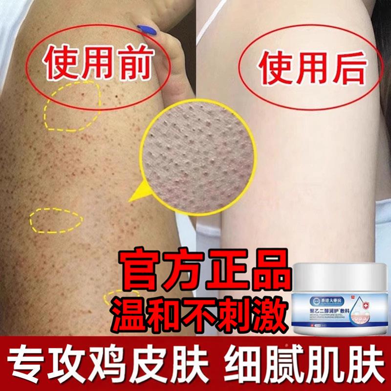香港医用聚乙二醇润护敷料儿童鸡皮肤毛囊化症专用去除官方角正品