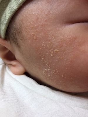 半岁宝宝湿疹老反复怎么办？我侄子用芊芙霜治好了湿疹