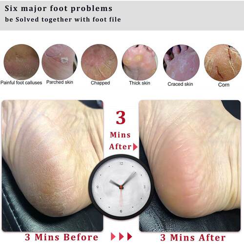 Foot File Callus Remover Scrubber Cracked Heels Dead Skin