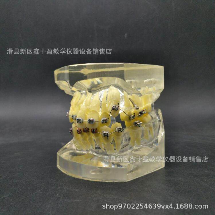 正失畸模型错颌矫正牙3005-3齿示范牙列不齐拥缺伸长展挤示带支抗