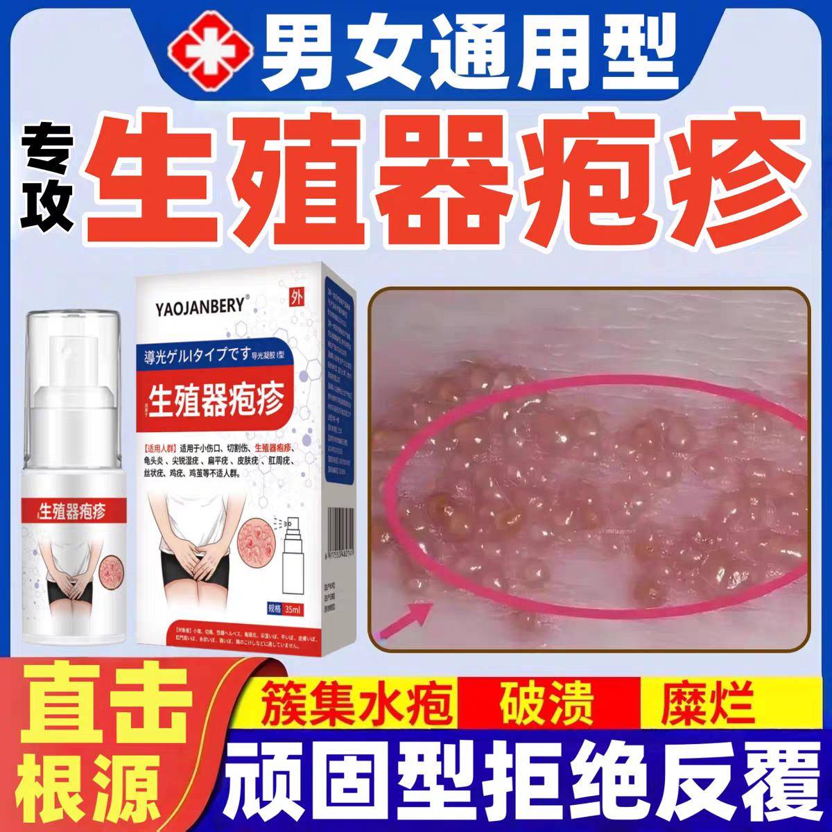 生殖器疱疹喷剂私处长小水泡糜烂瘙痒疼痛脓包真菌感染生殖疱疹膏