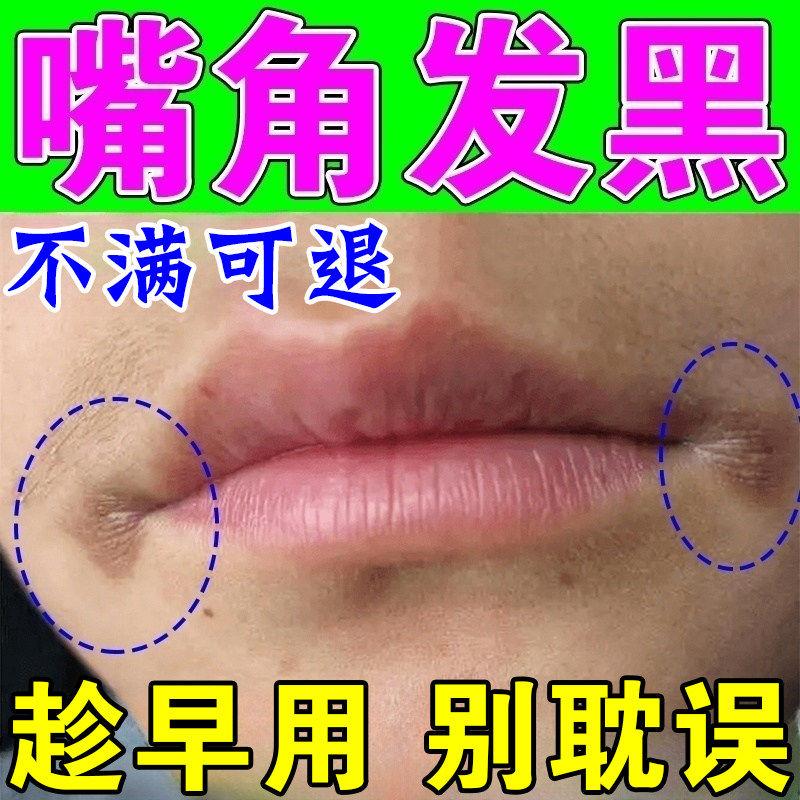 嘴角发黑去除嘴巴周边黑色素暗沉唇膜