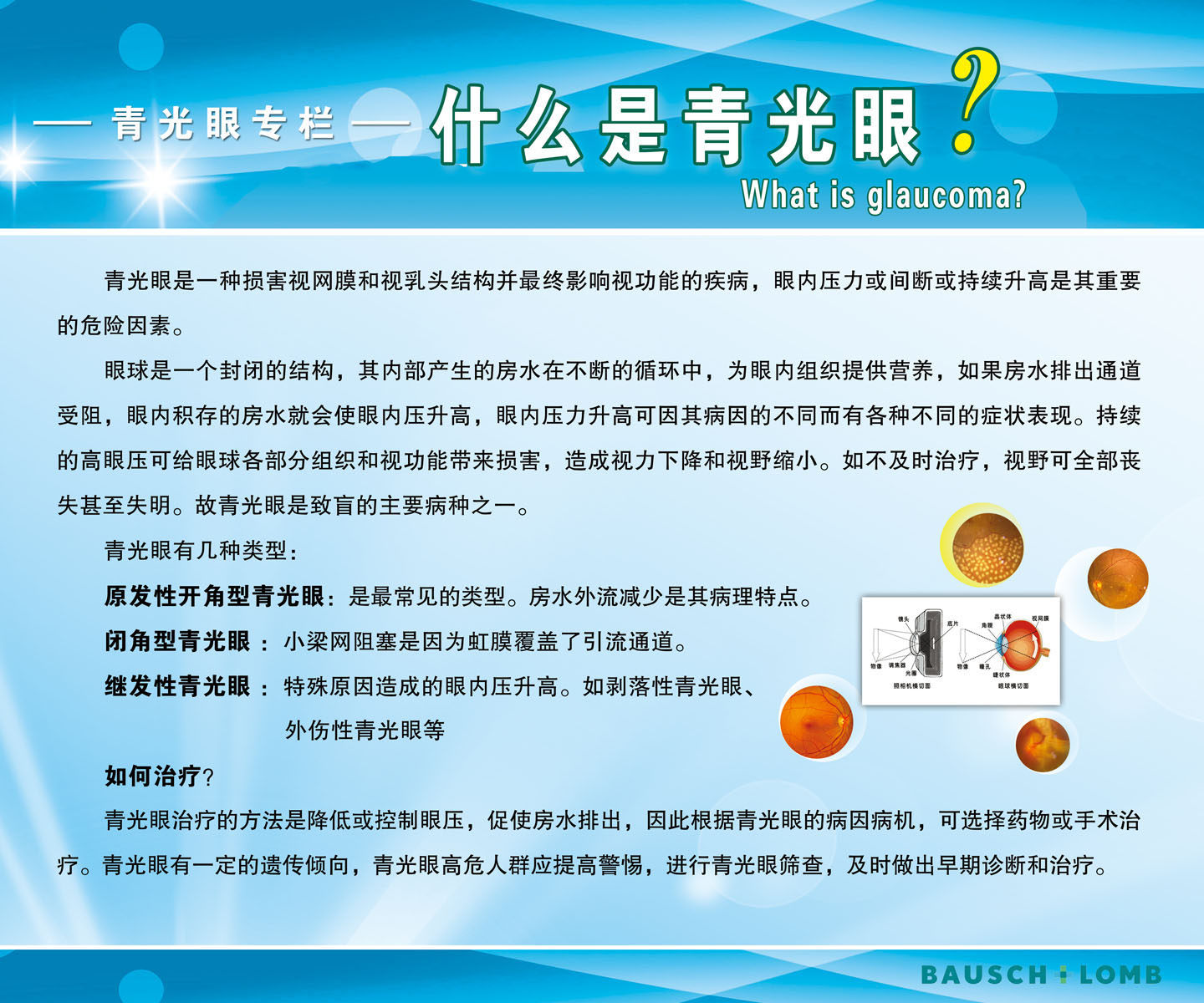 657海报印制展板素材794眼科什么是青光眼知识宣传