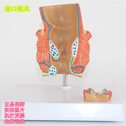 医用 直肠病理模型 肛肠科肛门括约肌解剖模型 直肠病变 痔