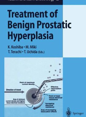 【预订】Treatment of Benign Prostatic Hyperplasia