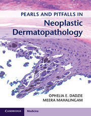 【预订】Pearls and Pitfalls in Neoplastic De...