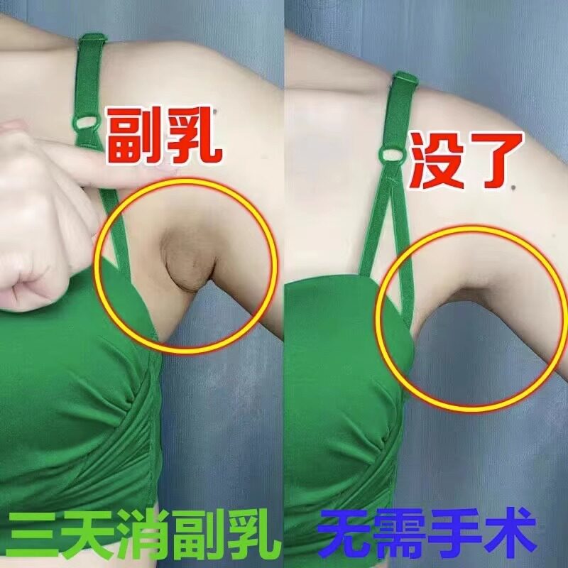 热销【 专攻液下淋巴】收副乳消除帖 消淋巴散结帖 去腋下结节ZP