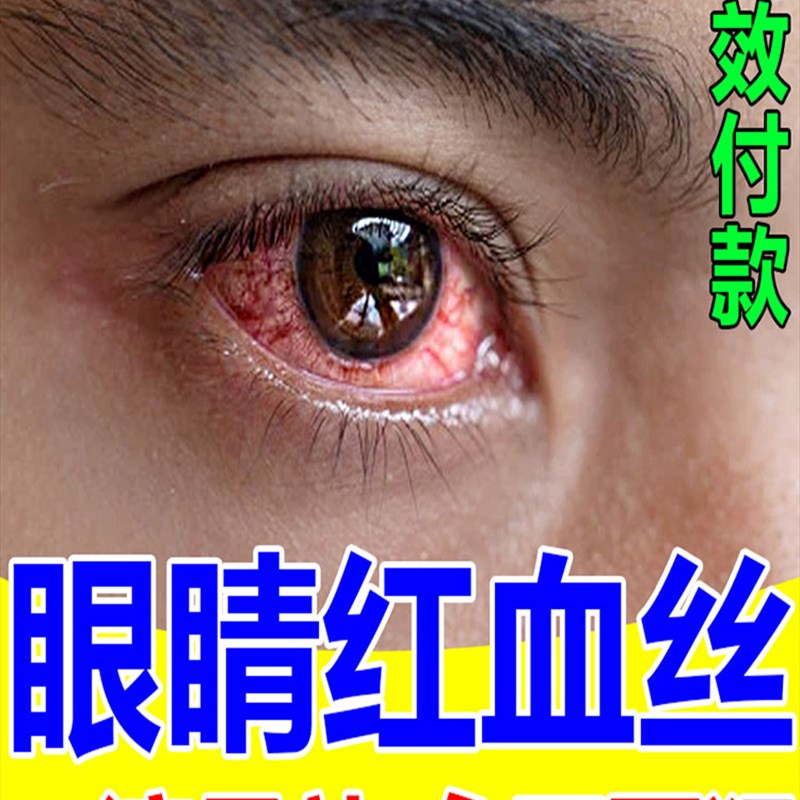 新品眼睛红血丝修l复去除结石去黄去红血丝缓解眼疲劳眼药水粘稠