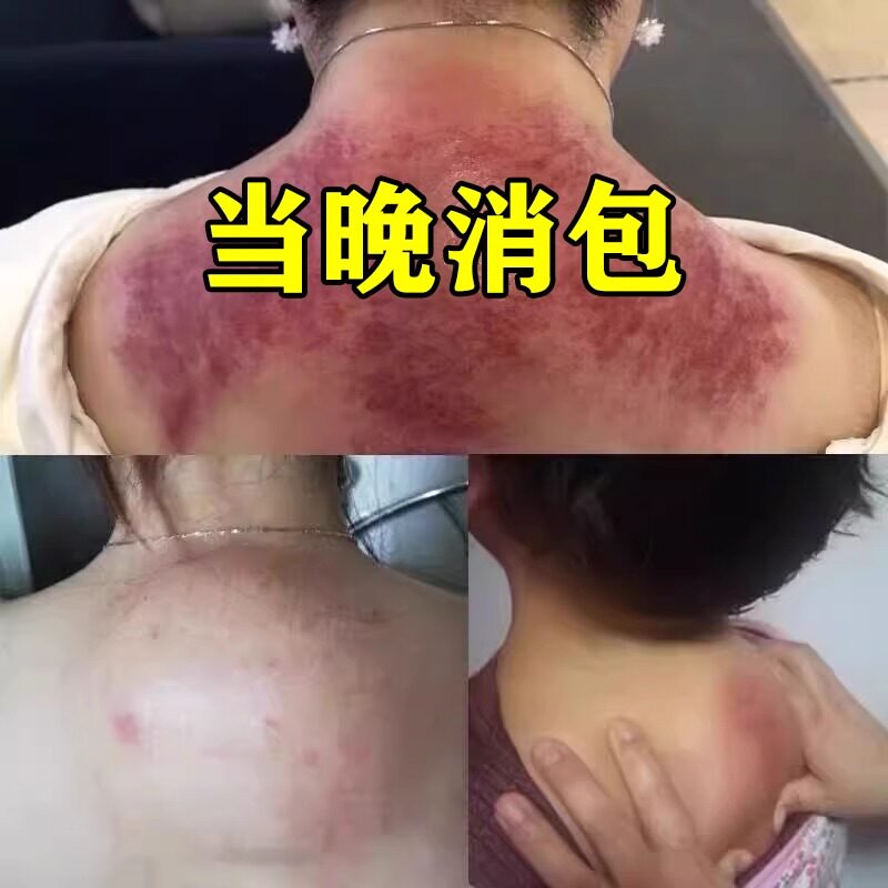 热销【上万人都在用】解决各种颈椎问题 只要富贵不要包 富贵包消