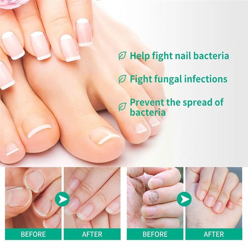 推荐Cure For Hand Foot  Toenail Fungus Fungistasis Toenail F