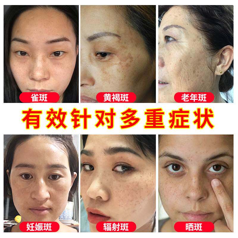 一抹净】去老年斑的药膏仪力去除手上褐部黄脸斑老年斑晒斑强神器