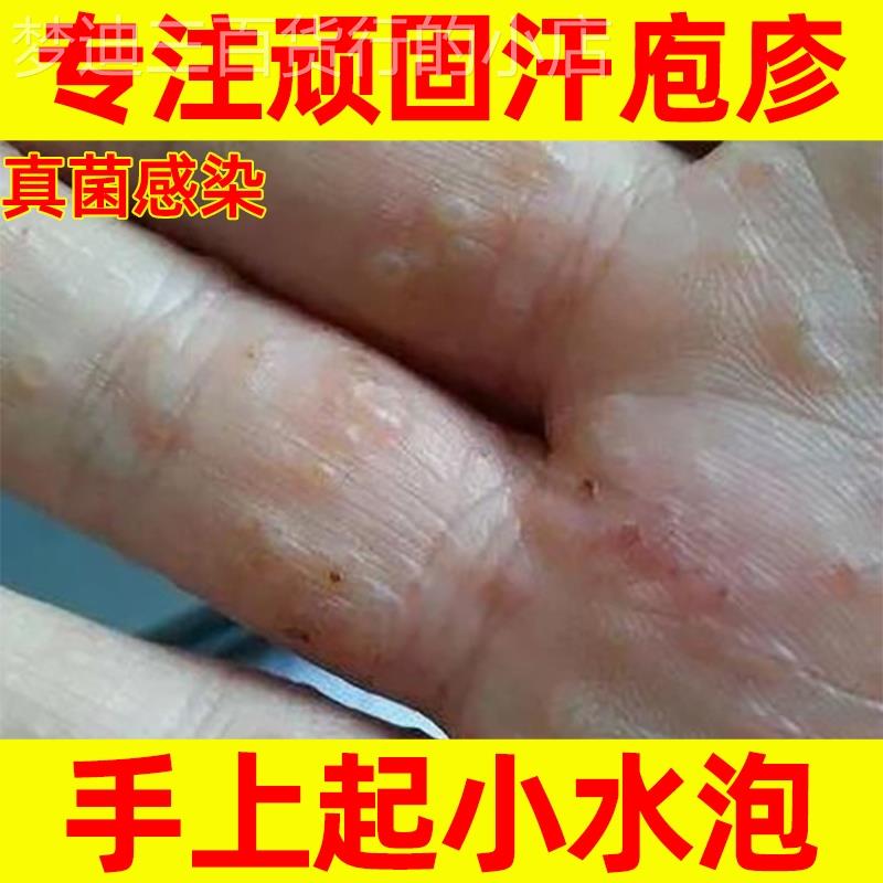 手上起小水泡皮癣净汗状疱疹专用软膏汗状疱疹手上小水泡苗家药膏