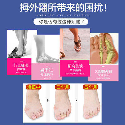 大拇指矫正器脚型矫正器鞋女脚趾头大脚骨儿童拇外翻日夜用可穿鞋